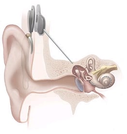 Cochlear Implant Diagram
